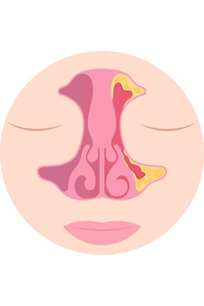 Imagen ilustrativa de una sinusitis aguda